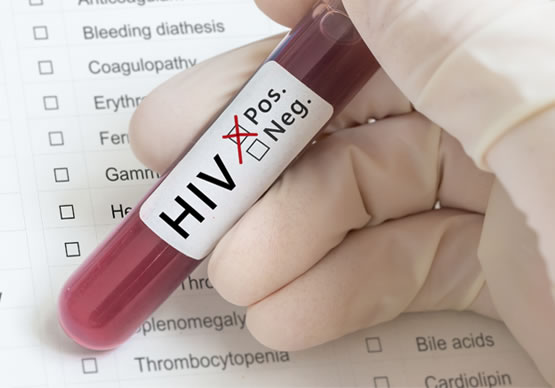 HIV testování